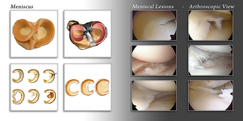 meniscal tear
