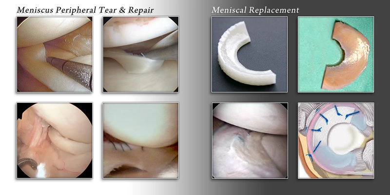 meniscal tear