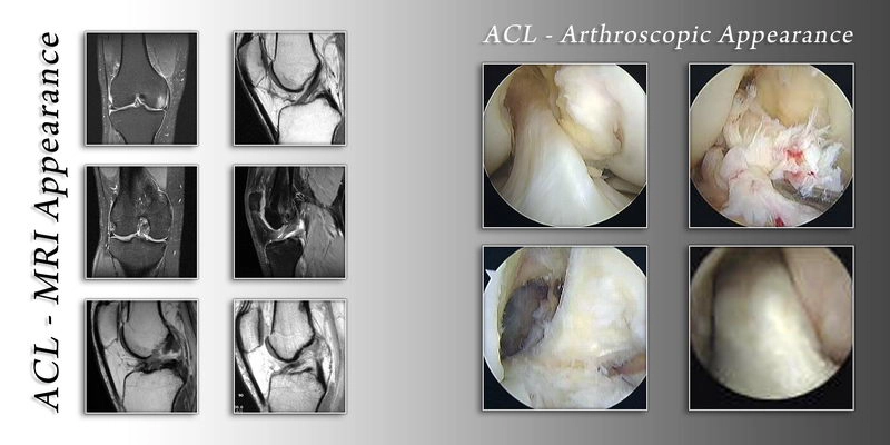 ligament