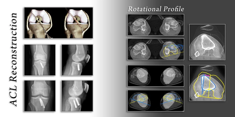 ligament reconstruction