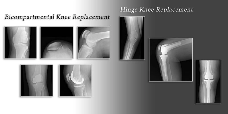 Alternative replacement methods replacement