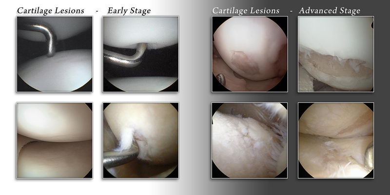 Images of cartilage lesions