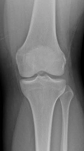 Knee X-ray investigations X-ray AP view