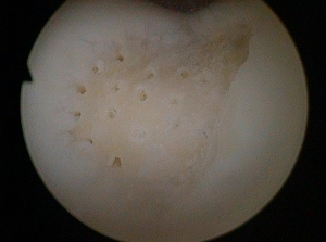 Cartilage Surgery