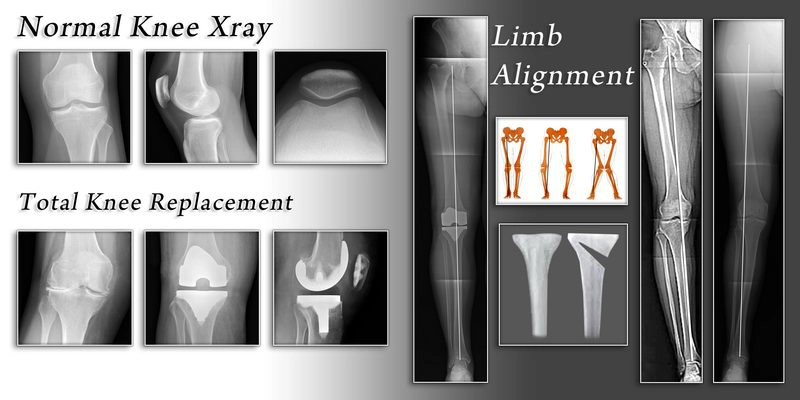 tkr alignment knee replacement
